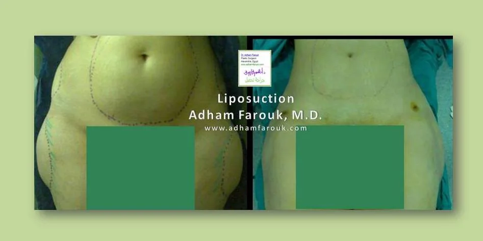 Dr. Adham Farouk - Body Sculpture Before and After Case 1