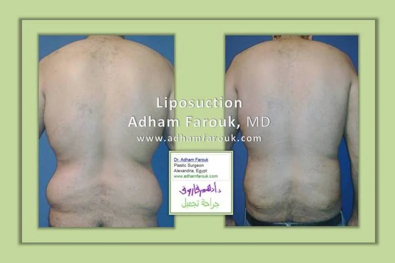 Dr. Adham Farouk - Body Sculpture Before and After Case 2