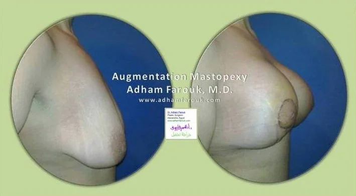 Dr. Adham Farouk - Breast Surgery Before and After Case 1