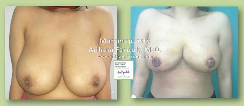 Dr. Adham Farouk - Breast Surgery Before and After Case 3