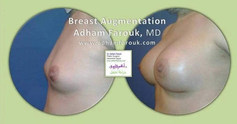 Dr. Adham Farouk - Breast Surgery Before and After Case 5
