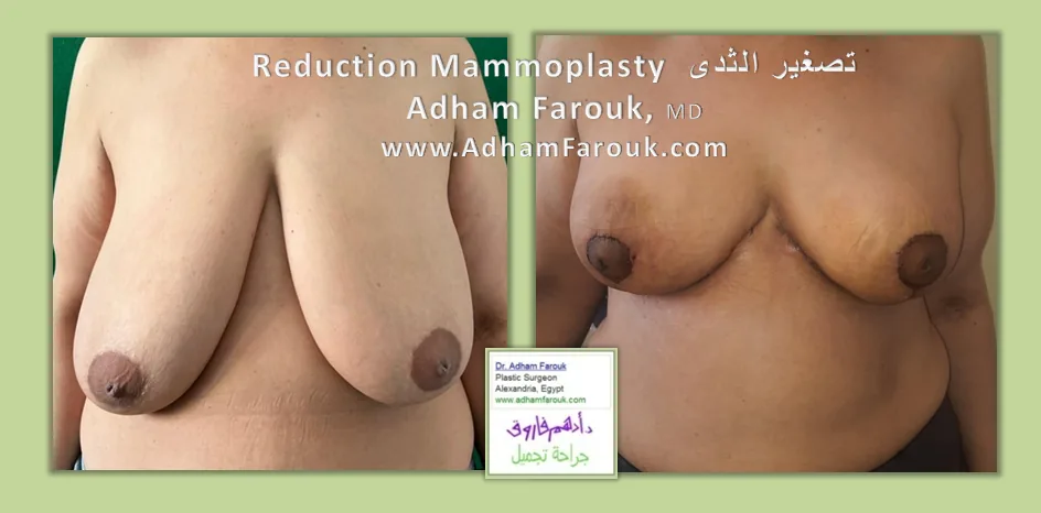 جراحة تجميل الثدي في الإسكندرية قبل وبعد