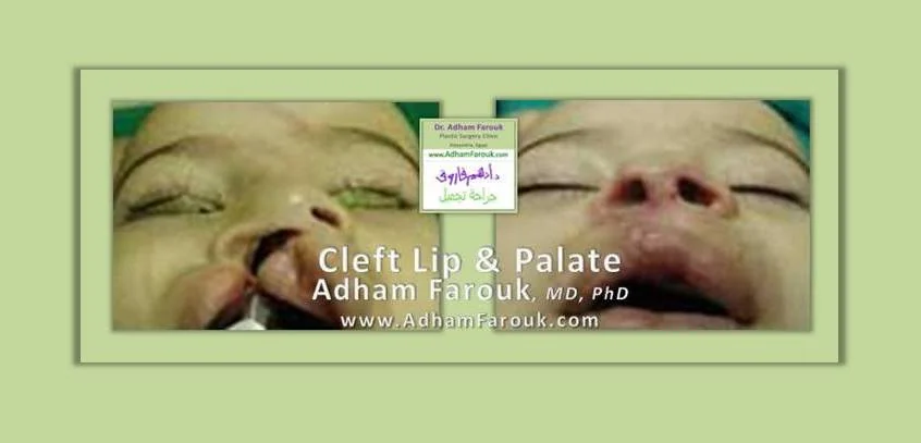 Dr. Adham Farouk - Cleft Lip Before and After Transformation Case 1