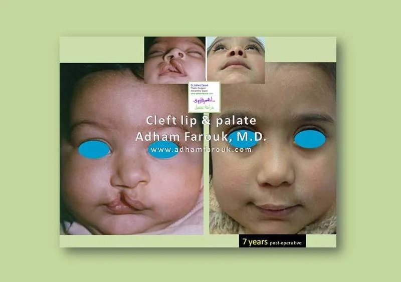 Dr. Adham Farouk - Cleft Lip Before and After Transformation Case 4
