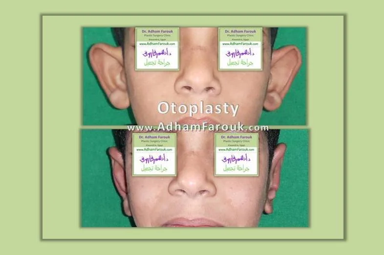 Dr. Adham Farouk - Ear Surgery Before and After Transformation Case 1
