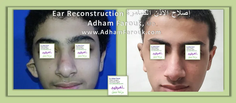 إصلاح تشوه الأذن الخلقي قبل وبعد