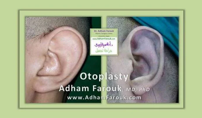 Dr. Adham Farouk - Ear Surgery Before and After Transformation Case 3