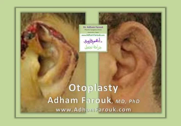 Dr. Adham Farouk - Ear Surgery Before and After Transformation Case 5