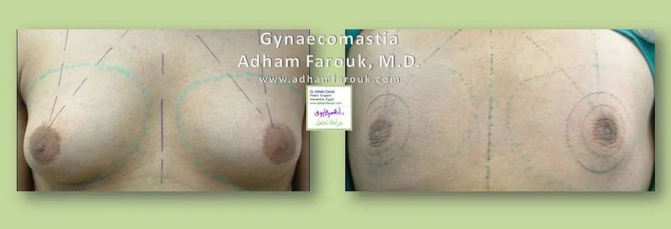 Dr. Adham Farouk - Male Breast Surgery Before and After Case 1