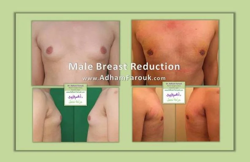 Dr. Adham Farouk - Male Breast Surgery Before and After Case 2