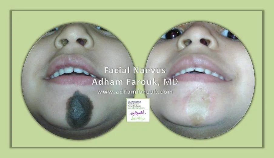Dr. Adham Farouk - Nevus Removal Before and After Case 1