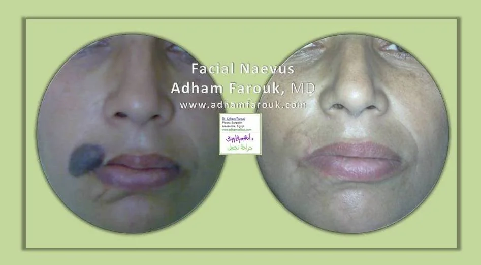 Dr. Adham Farouk - Nevus Removal Before and After Case 2