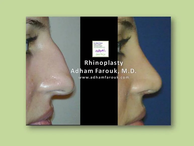 Dr. Adham Farouk - Rhinoplasty Before and After Case 1