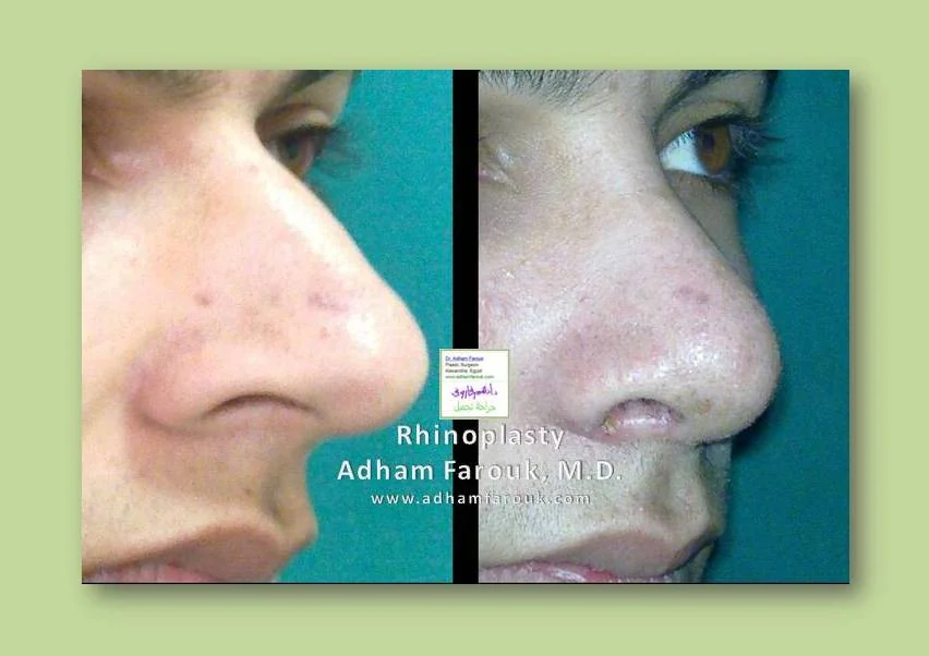 Dr. Adham Farouk - Rhinoplasty Before and After Case 2
