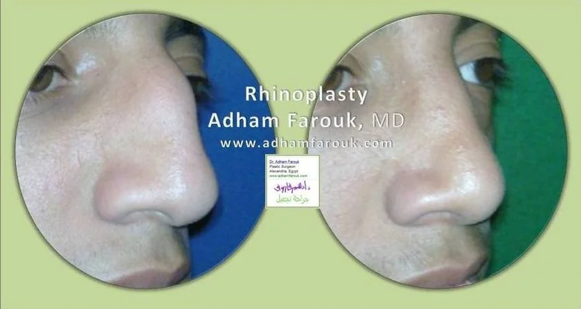 Dr. Adham Farouk - Rhinoplasty Before and After Case 6