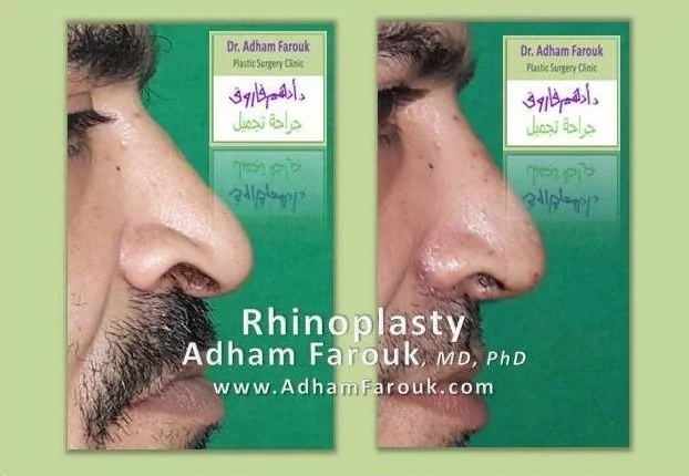 Dr. Adham Farouk - Rhinoplasty Before and After Case 10