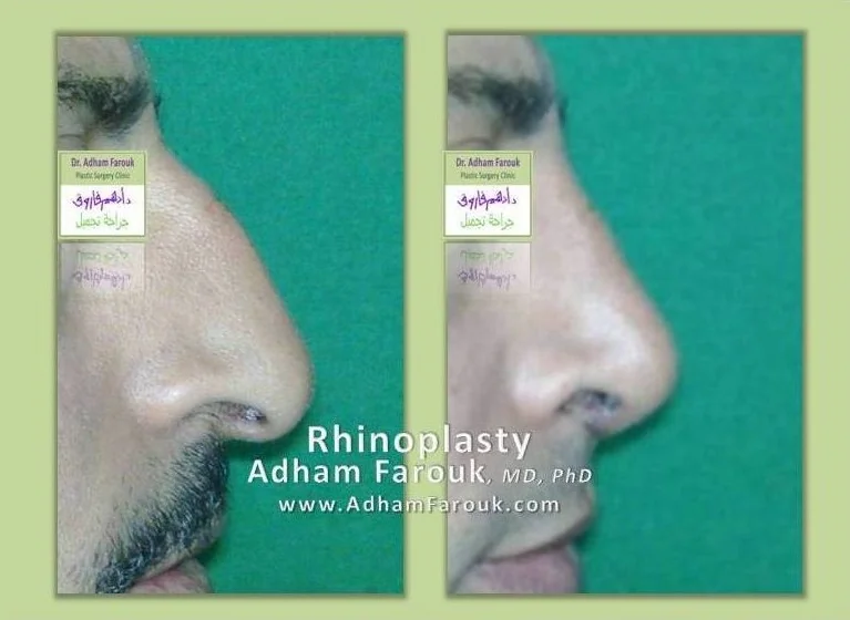 Dr. Adham Farouk - Rhinoplasty Before and After Case 11