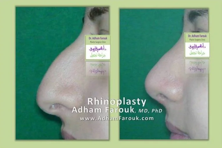 Dr. Adham Farouk - Rhinoplasty Before and After Case 13
