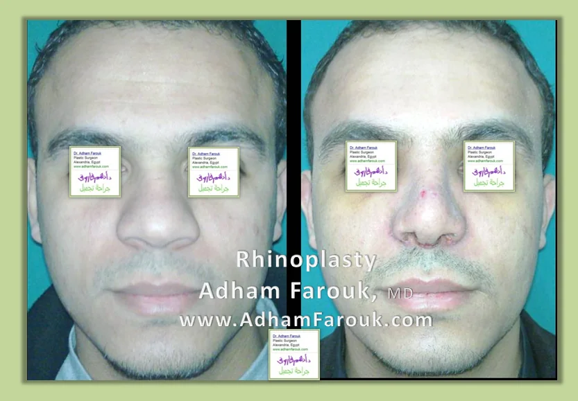 تحوّل شكل الأنف بالتجميل قبل وبعد