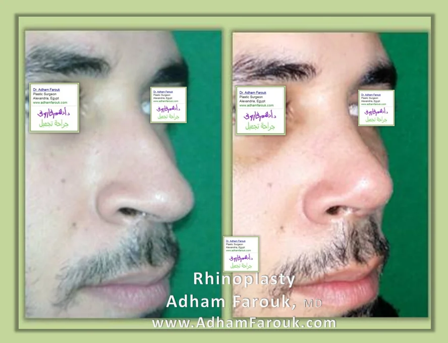 نتائج عملية تجميل الأنف قبل وبعد