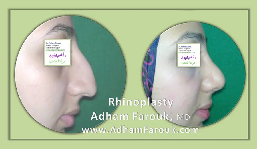 تجميل الأنف النسائي قبل وبعد