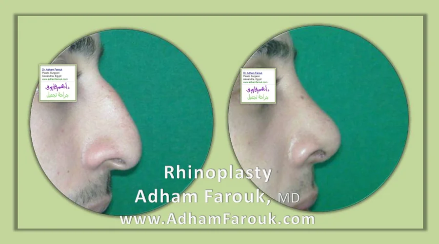 نتائج جراحة الأنف التجميلية قبل وبعد