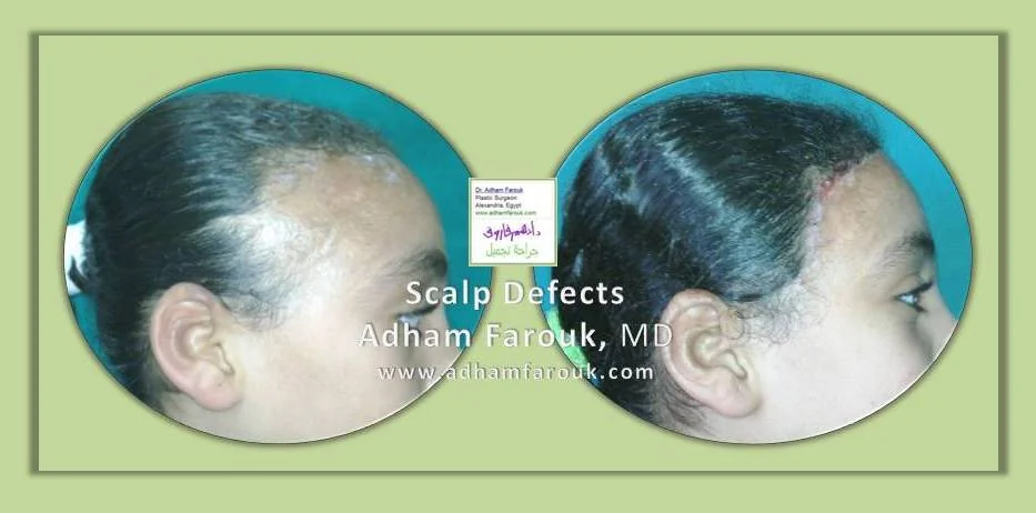 Dr. Adham Farouk - Scars and Scalp Before and After Case 2